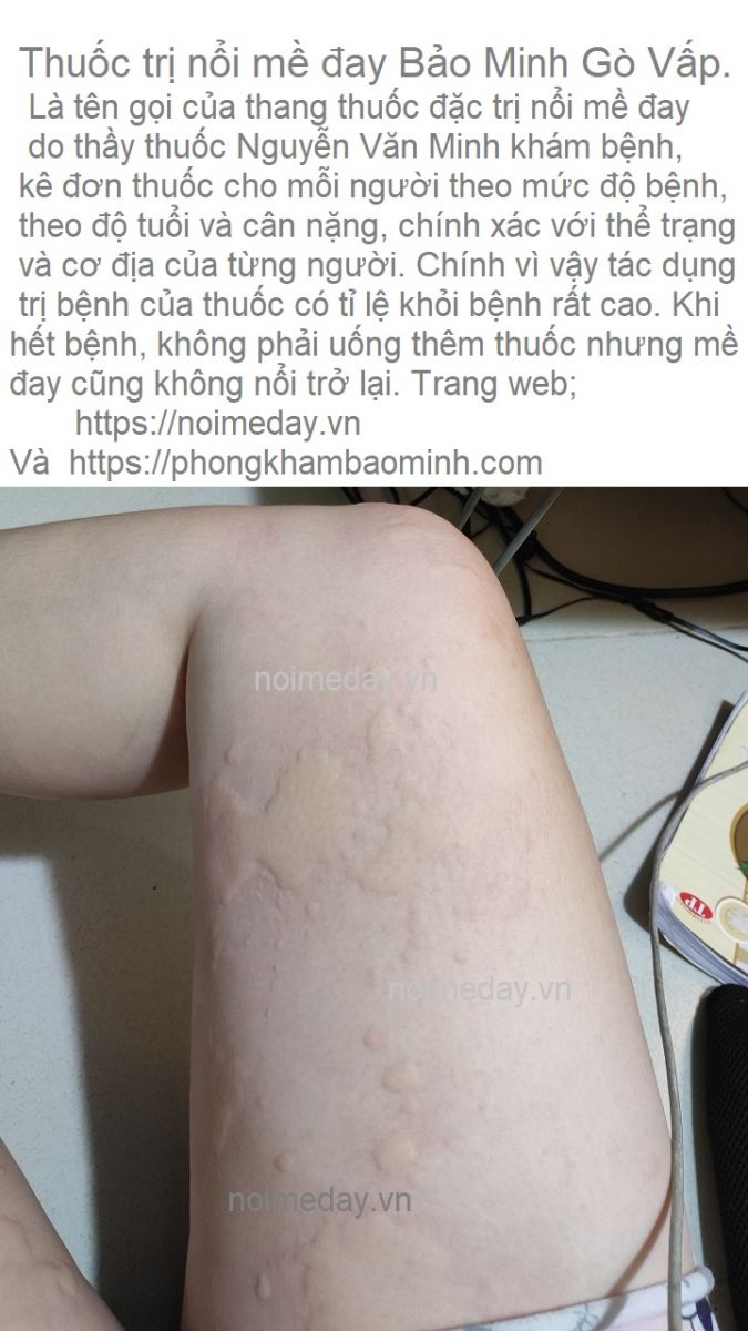 Thuốc trị nổi mề đay 